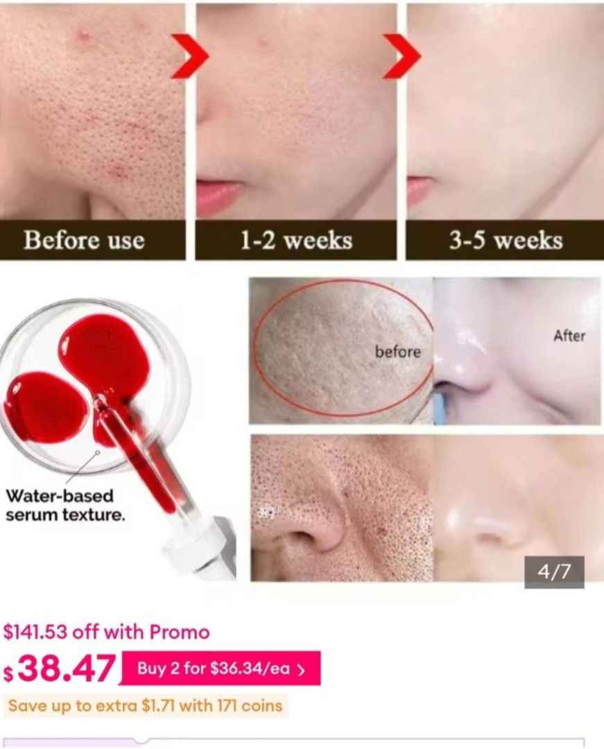 The Ordinary Peeling Solution. Postage cost shown below 👇 (Category: Face Care) located in Singapore. Submitted by kristalbeaute (Listing ID 1458333260, Image 3). Description: I don't reply messages for free items Just click 'Pay Postage ' to pay postage via Carousell. No Self collect/ meet up (will block) How to pay postage: Click Pay Postage Click Add Deal Method Choose shipping The Ordinary AHA 30% + BHA 2% Peeling Solution 10 minute Exfoliat